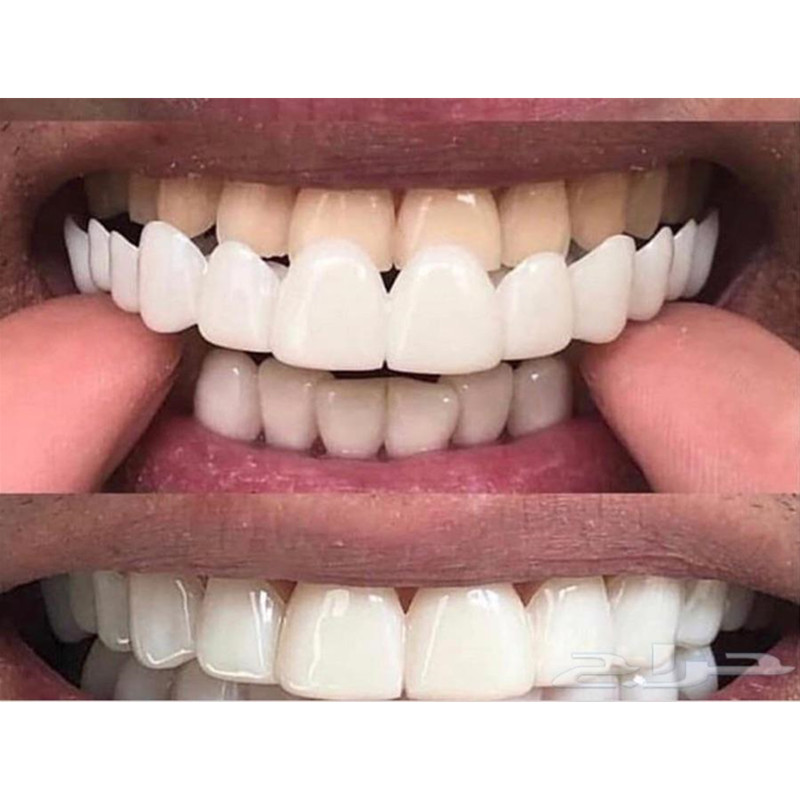 Мягкая силиконовая гелевая нак – обзор и цена Teeth Whitening Moulds
