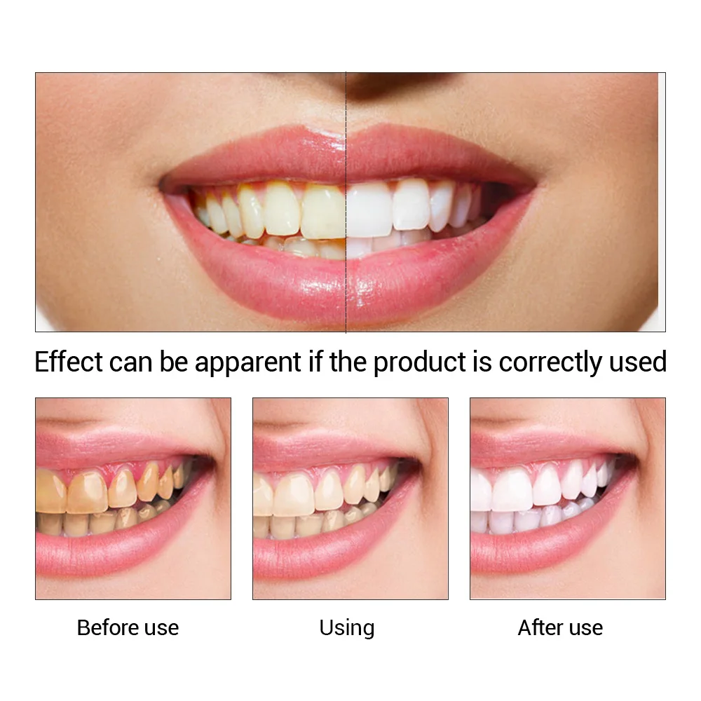 FTEENPLY отбеливание зубов быс – обзор и цена Teeth Whitening Near Me