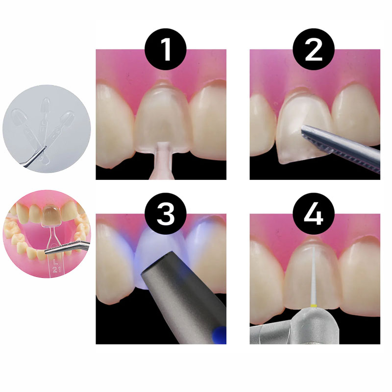 Набор из 32 форм для композитн – обзор и цена Teeth Whitening Moulds