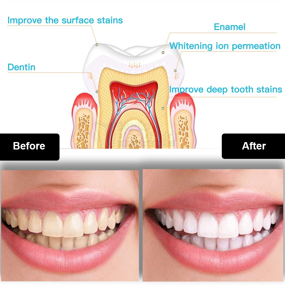 Набор для отбеливания зубов, м – обзор и цена Teeth Whitening Near Me