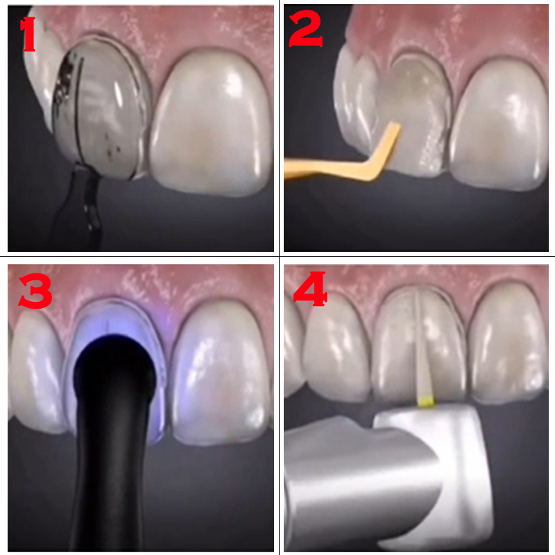 Автоклавируемая форма для изго – обзор и цена Teeth Whitening Moulds