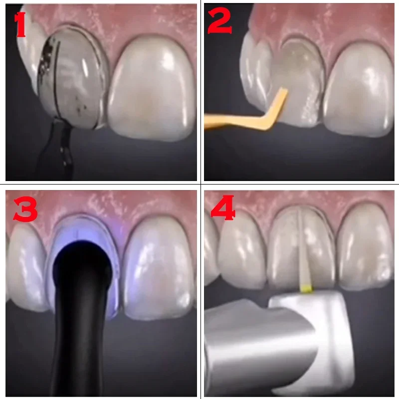 Зуботехнические формы для комп – обзор и цена Teeth Whitening Moulds