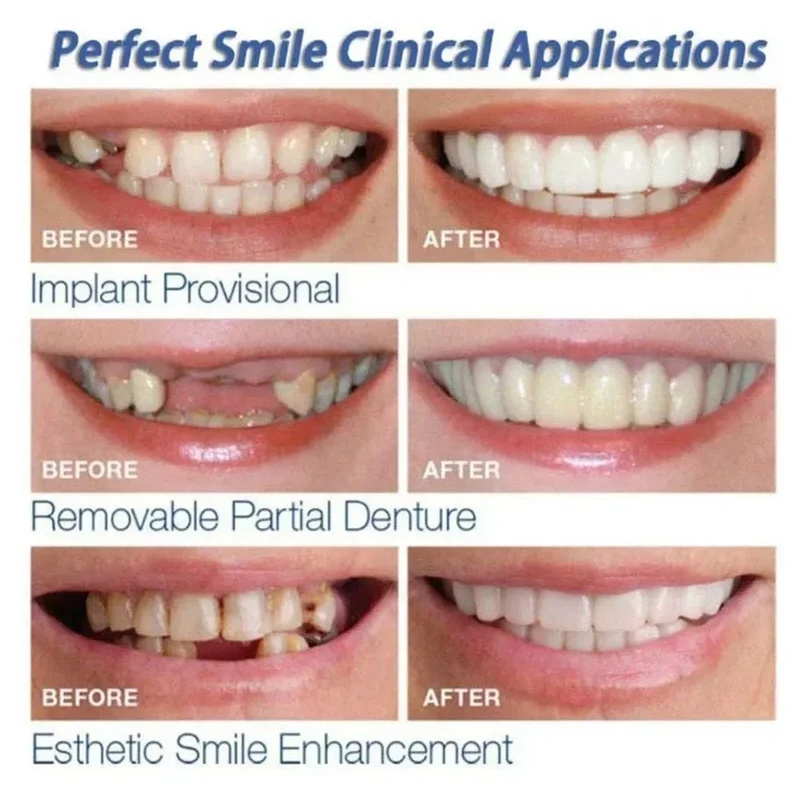 Набор временных косметических  – обзор и цена Teeth Whitening Kit