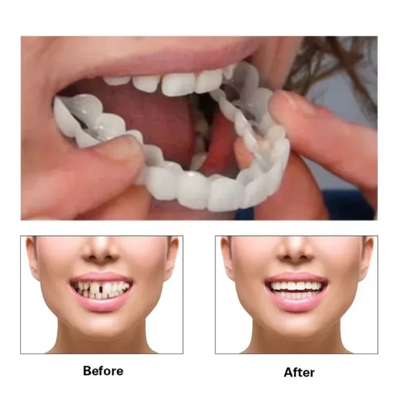 Набор временных косметических  – обзор и цена Teeth Whitening Kit